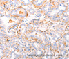 Immunohistochemistry of paraffin-embedded Human thyroid cancer using ABCA4 Polyclonal Antibody at dilution of 1:30