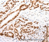 Immunohistochemistry of paraffin-embedded Human colon cancer tissue using CASP9 (active) Polyclonal Antibody at dilution 1:80