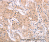 Immunohistochemistry of paraffin-embedded Human breast cancer using ADAM11 Polyclonal Antibody at dilution of 1:40