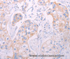 Immunohistochemistry of paraffin-embedded Human breast cancer tissue using ADAMTS14 Polyclonal Antibody at dilution 1:50