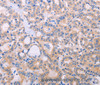Immunohistochemistry of paraffin-embedded Human thyroid cancer tissue using ADCY5 Polyclonal Antibody at dilution 1:30