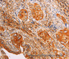 Immunohistochemistry of paraffin-embedded Human cervical cancer using SLC25A4 Polyclonal Antibody at dilution of 1:40