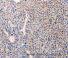 Immunohistochemistry of paraffin-embedded Human liver cancer using ADCY1 Polyclonal Antibody at dilution of 1:60