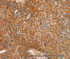 Immunohistochemistry of paraffin-embedded Human liver cancer tissue using ALDH1A2 Polyclonal Antibody at dilution 1:30
