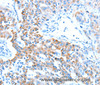 Immunohistochemistry of paraffin-embedded Human lung cancer tissue using ALDH5A1 Polyclonal Antibody at dilution 1:60