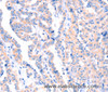 Immunohistochemistry of paraffin-embedded Human thyroid cancer tissue using APBA2 Polyclonal Antibody at dilution 1:80