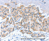 Immunohistochemistry of paraffin-embedded Human breast cancer using APOBEC3D Polyclonal Antibody at dilution of 1:80