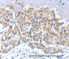 Immunohistochemistry of paraffin-embedded Human breast cancer using APOBEC3D Polyclonal Antibody at dilution of 1:80