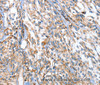 Immunohistochemistry of paraffin-embedded Human esophagus cancer using APOBEC3D Polyclonal Antibody at dilution of 1:80