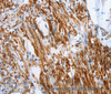 Immunohistochemistry of paraffin-embedded Human colon cancer tissue using SHROOM2 Polyclonal Antibody at dilution 1:50