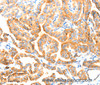 Immunohistochemistry of paraffin-embedded Human thyroid cancer tissue using MANF Polyclonal Antibody at dilution 1:70