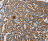 Immunohistochemistry of paraffin-embedded Human thyroid cancer using UPF1 Polyclonal Antibody at dilution of 1:35