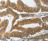 Immunohistochemistry of paraffin-embedded Human colon cancer tissue using PIK3R3 Polyclonal Antibody at dilution 1:45