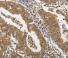 Immunohistochemistry of paraffin-embedded Human gastric cancer tissue using PIK3R3 Polyclonal Antibody at dilution 1:45