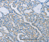 Immunohistochemistry of paraffin-embedded Human thyroid cancer tissue using NEK5 Polyclonal Antibody at dilution 1:60