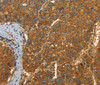 Immunohistochemistry of paraffin-embedded Human liver cancer tissue using PFKFB1 Polyclonal Antibody at dilution 1:60