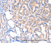 Immunohistochemistry of paraffin-embedded Human thyroid cancer using THBS1 Polyclonal Antibody at dilution of 1:50