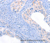 Immunohistochemistry of paraffin-embedded Human cervical cancer using THBS1 Polyclonal Antibody at dilution of 1:50