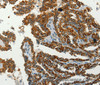 Immunohistochemistry of paraffin-embedded Human thyroid cancer using SERPINA9 Polyclonal Antibody at dilution of 1:60