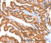 Immunohistochemistry of paraffin-embedded Human thyroid cancer tissue using AK5 Polyclonal Antibody at dilution 1:60