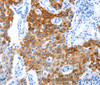 Immunohistochemistry of paraffin-embedded Human lung cancer tissue using CD133 Polyclonal Antibody at dilution 1:40