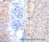 Immunohistochemistry of paraffin-embedded Human cervical cancer tissue using ANK3 Polyclonal Antibody at dilution 1:50