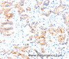 Immunohistochemistry of paraffin-embedded Human colon cancer tissue using CCDC88A Polyclonal Antibody at dilution 1:50