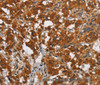 Immunohistochemistry of paraffin-embedded Human thyroid cancer tissue using SMAD9 Polyclonal Antibody at dilution 1:40