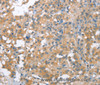 Immunohistochemistry of paraffin-embedded Human thyroid cancer tissue using NLRP7 Polyclonal Antibody at dilution 1:40