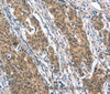 Immunohistochemistry of paraffin-embedded Human gastric cancer tissue using BNIP3L Polyclonal Antibody at dilution 1:40