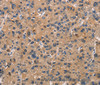 Immunohistochemistry of paraffin-embedded Human liver cancer using ATP7A  Polyclonal Antibody at dilution of 1:50