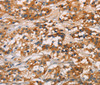 Immunohistochemistry of paraffin-embedded Human thyroid cancer tissue using CD80 Polyclonal Antibody at dilution 1:50