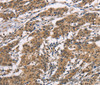 Immunohistochemistry of paraffin-embedded Human gasrtic cancer tissue using ADGRB1 Polyclonal Antibody at dilution 1:40