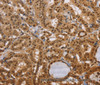 Immunohistochemistry of paraffin-embedded Human thyroid cancer using CEL Polyclonal Antibody at dilution of 1:40