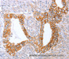 Immunohistochemistry of paraffin-embedded Human cervical cancer tissue using ABO Polyclonal Antibody at dilution 1:50