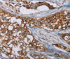 Immunohistochemistry of paraffin-embedded Human breast cancer using BMP6 Polyclonal Antibody at dilution of 1:50