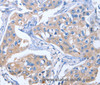 Immunohistochemistry of paraffin-embedded Human breast cancer tissue using IBSP Polyclonal Antibody at dilution of 1:50