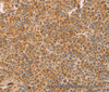Immunohistochemistry of paraffin-embedded Human liver cancer tissue using BRS3 Polyclonal Antibody at dilution 1:30