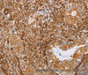 Immunohistochemistry of paraffin-embedded Human cervical cancer tissue using BRS3 Polyclonal Antibody at dilution 1:30