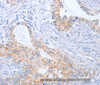 Immunohistochemistry of paraffin-embedded Human cervical cancer tissue using BST1 Polyclonal Antibody at dilution 1:50