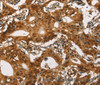 Immunohistochemistry of paraffin-embedded Human gasrtic cancer tissue using Cav1.2 Polyclonal Antibody at dilution 1:30