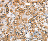 Immunohistochemistry of paraffin-embedded Human thyroid cancer tissue using Cav1.2 Polyclonal Antibody at dilution 1:30
