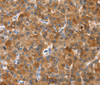 Immunohistochemistry of paraffin-embedded Human liver cancer tissue using NOD2 Polyclonal Antibody at dilution 1:40