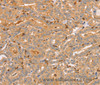 Immunohistochemistry of paraffin-embedded Human thyroid cancer tissue using CCL16  Polyclonal Antibody at dilution 1:60