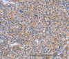 Immunohistochemistry of paraffin-embedded Human liver cancer using CD328 Polyclonal Antibody at dilution of 1:50