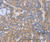 Immunohistochemistry of paraffin-embedded Human thyroid cancer using CD328 Polyclonal Antibody at dilution of 1:50