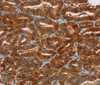 Immunohistochemistry of paraffin-embedded Human thyroid cancer tissue using NCR1 Polyclonal Antibody at dilution 1:30