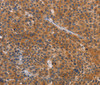 Immunohistochemistry of paraffin-embedded Human liver cancer tissue using NCR1 Polyclonal Antibody at dilution 1:30
