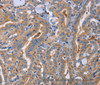 Immunohistochemistry of paraffin-embedded Human thyroid cancer using CD327 Polyclonal Antibody at dilution of 1:70