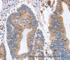 Immunohistochemistry of paraffin-embedded Human colon cancer using CD327 Polyclonal Antibody at dilution of 1:70